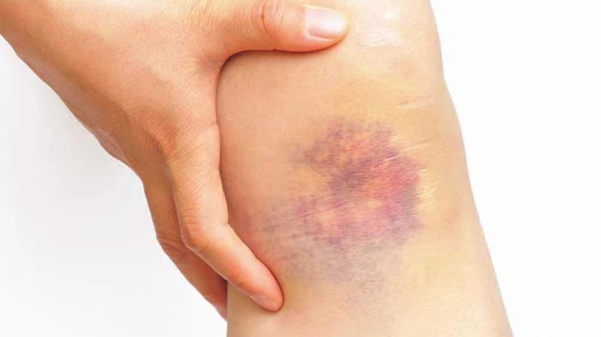 what-causes-bruises-on-legs-arms_-top-5-causes-of-bruising-covered-by-dr-berg-0-25-screenshot
