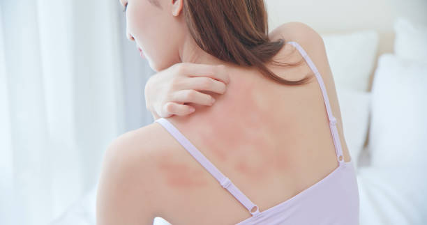 asian-beauty-woman-has-dry-skin-and-scratching-her-back