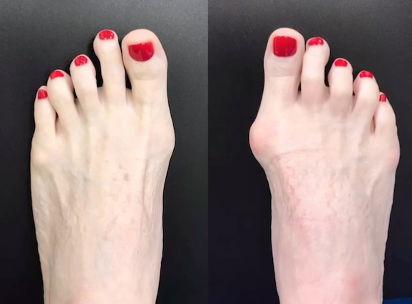 bunions