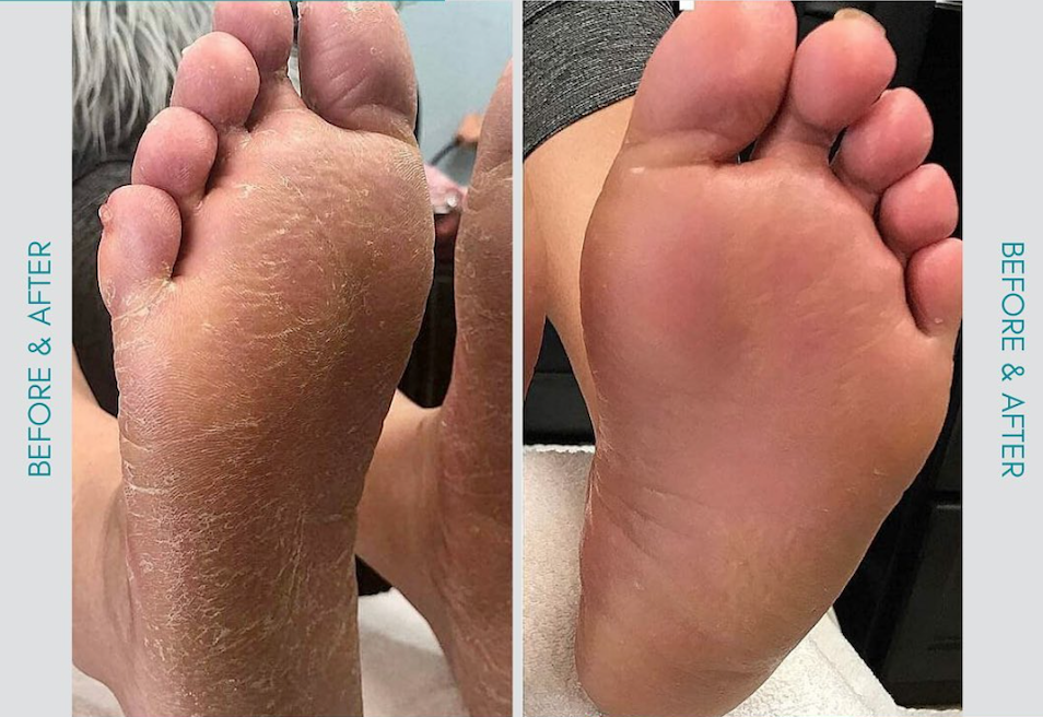 callus