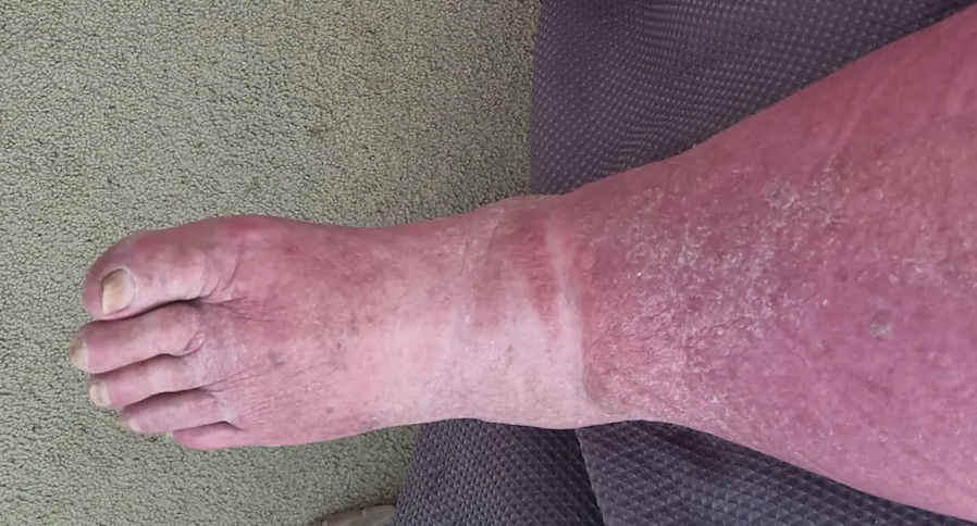 cellulitis
