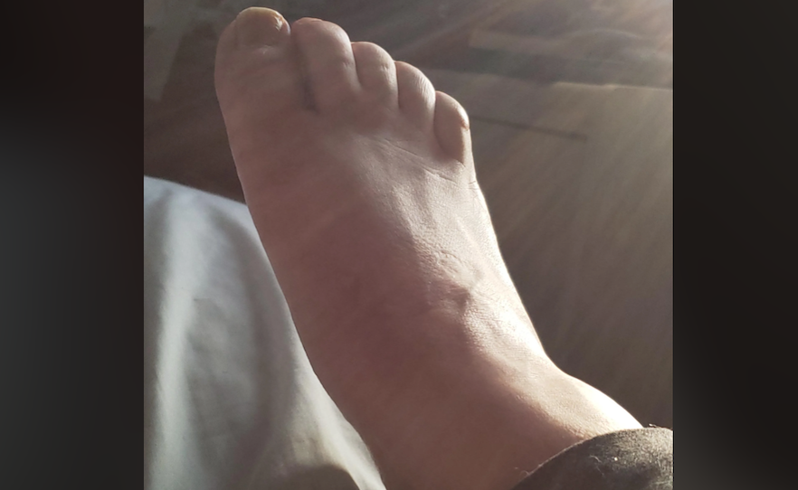 charcot