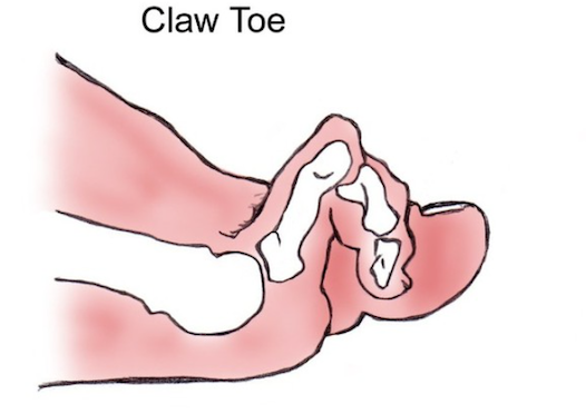clawtoe