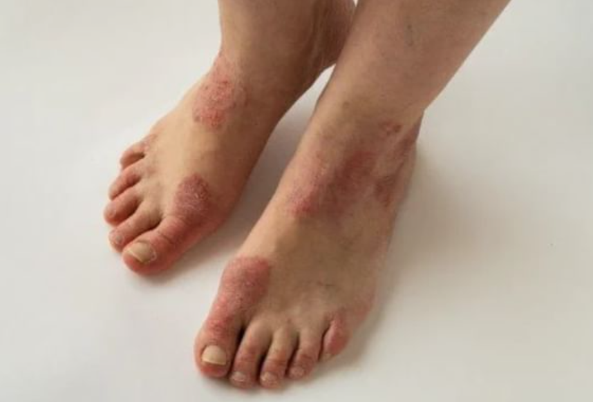 eczema