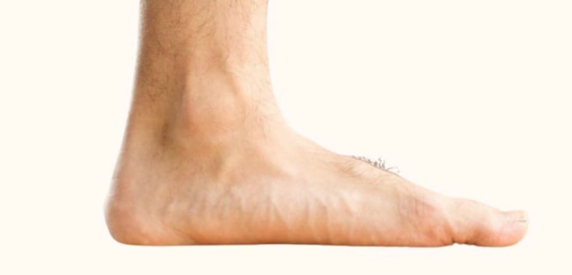 flat-feet