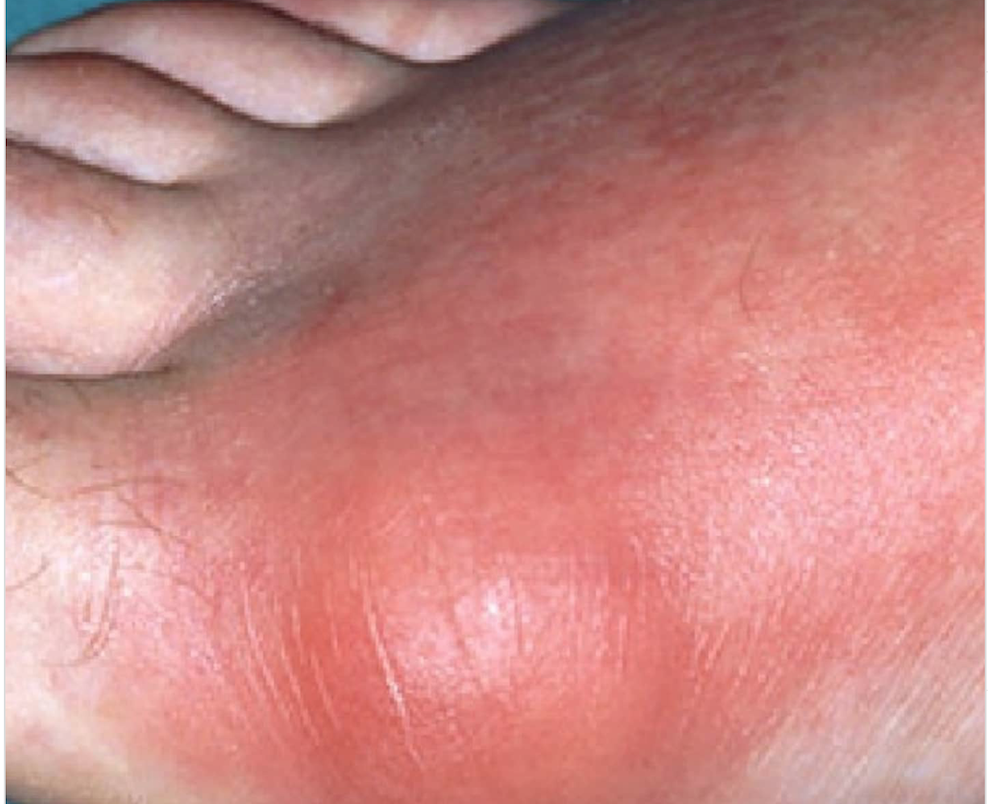 gout
