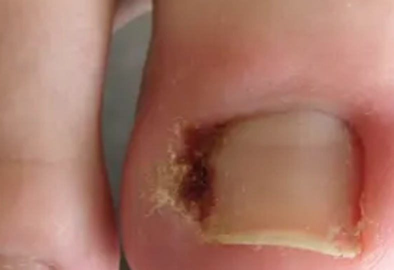 ingrown