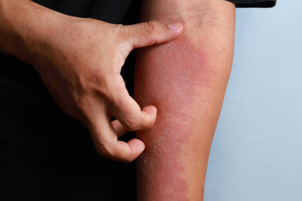 man-scratching-his-arm-medical-atopic-eczema-allergy-texture-of-ill-human-skin