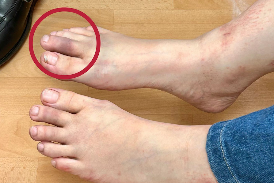 psoriaticarthritis