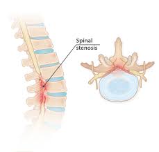 spinal-stenosis