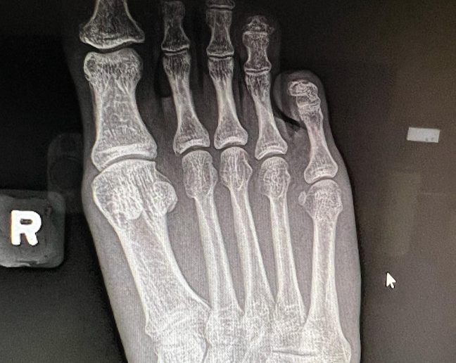 stressfracture