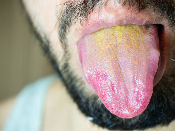 male-mouth-with-protruding-tongue-with-a-yellow-coating-at-the-base