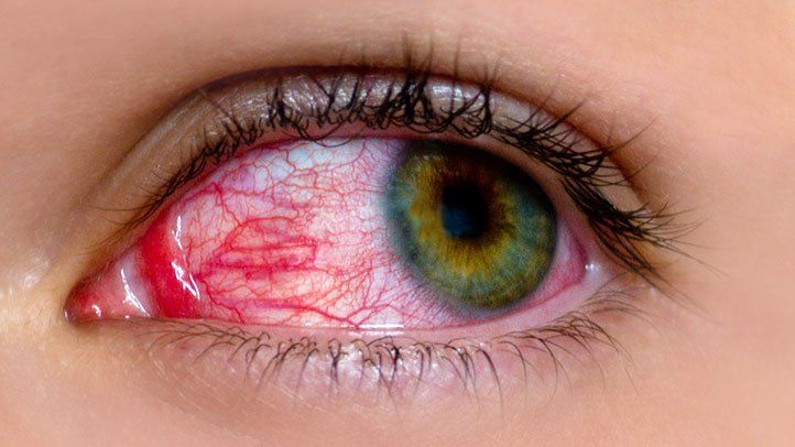 common-myths-about-pink-eye-722x406