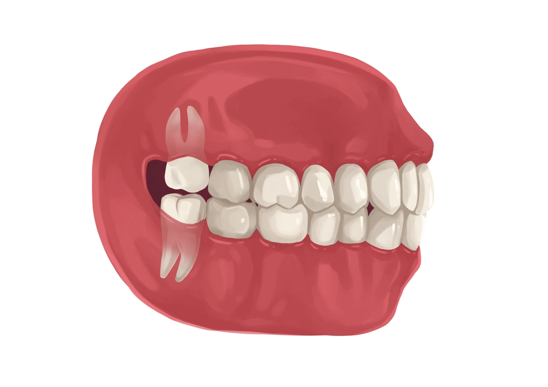 erupted-wisdom-tooth-technical-picture_50729003103_o