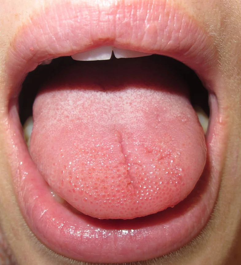 1-burning-tongue-popular-science