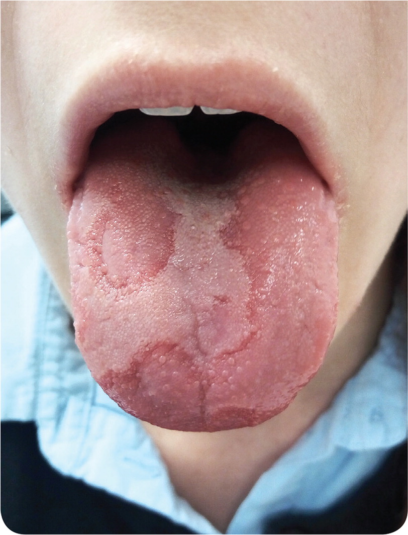 11-patchy-tongue-aafp