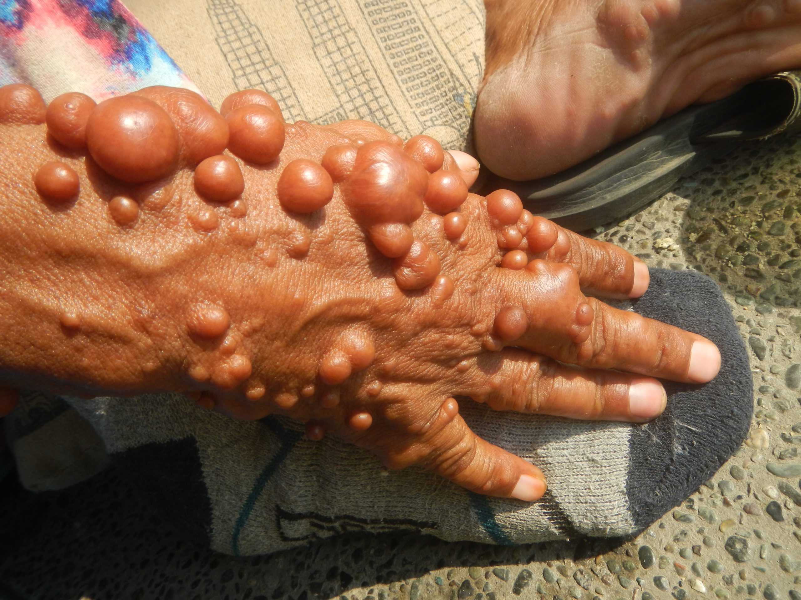 9913people_with_neurofibromatosis_in_the_philippines_06