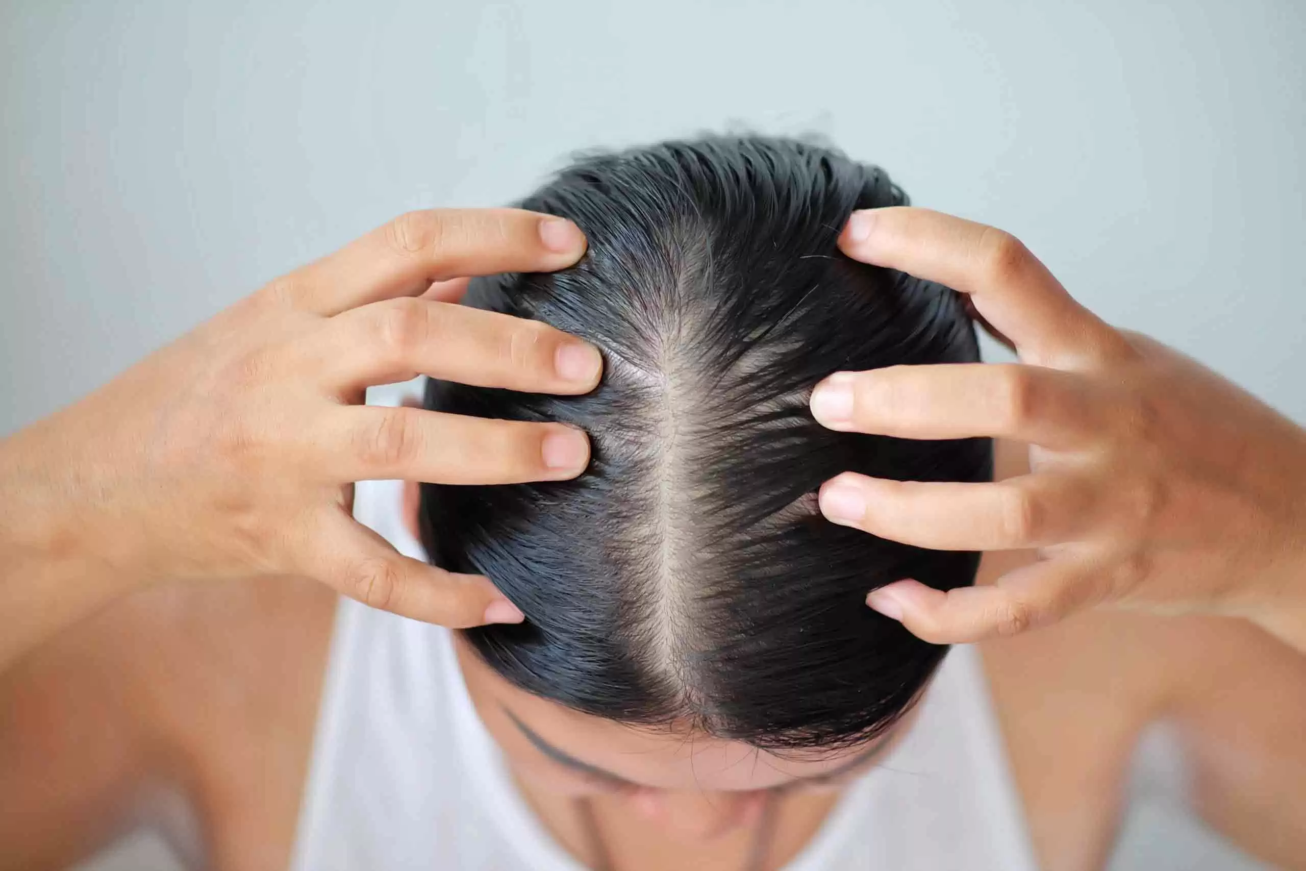 hair-loss-in-women-everything-you-need-to-know