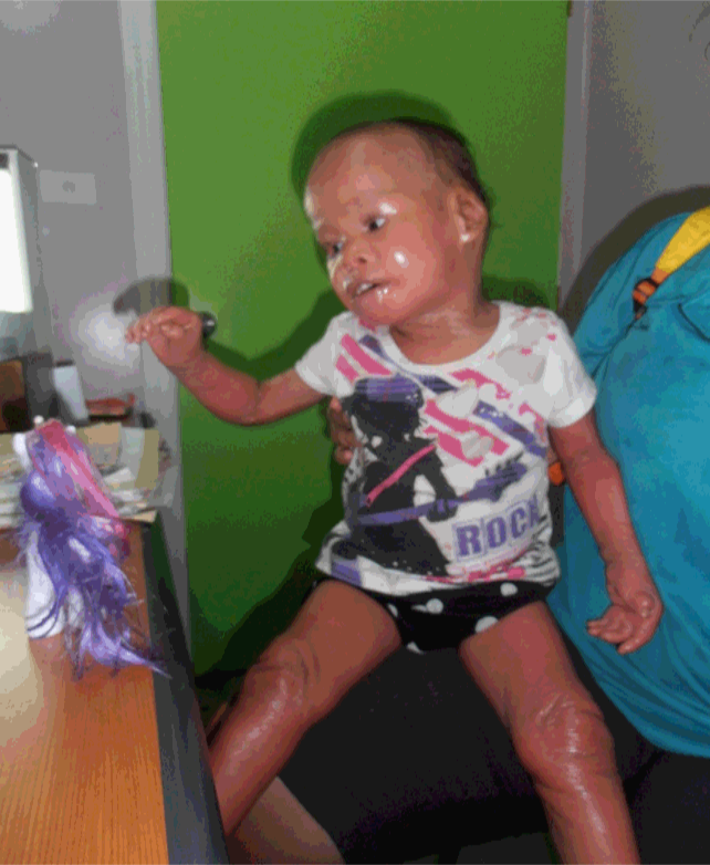 harlequin_ichthyosis_2