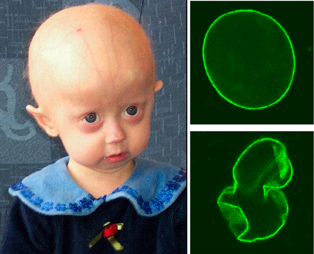 hutchinson-gilford_progeria_syndrome