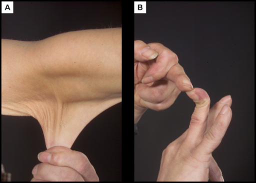 hyperelastic_skin__hypermobile_finger_in_a_case_of_ehlers-danlos_syndrome