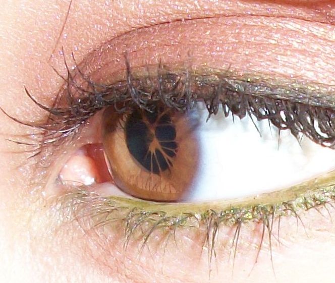 persistent_pupillary_membrane_-_fireinthexdisco