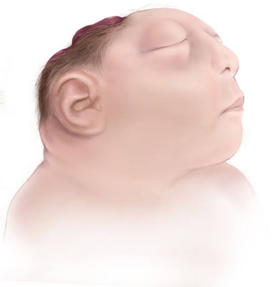 anencephalic-baby-a6a02d-small