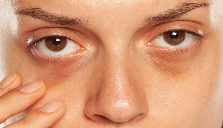 dark-circles