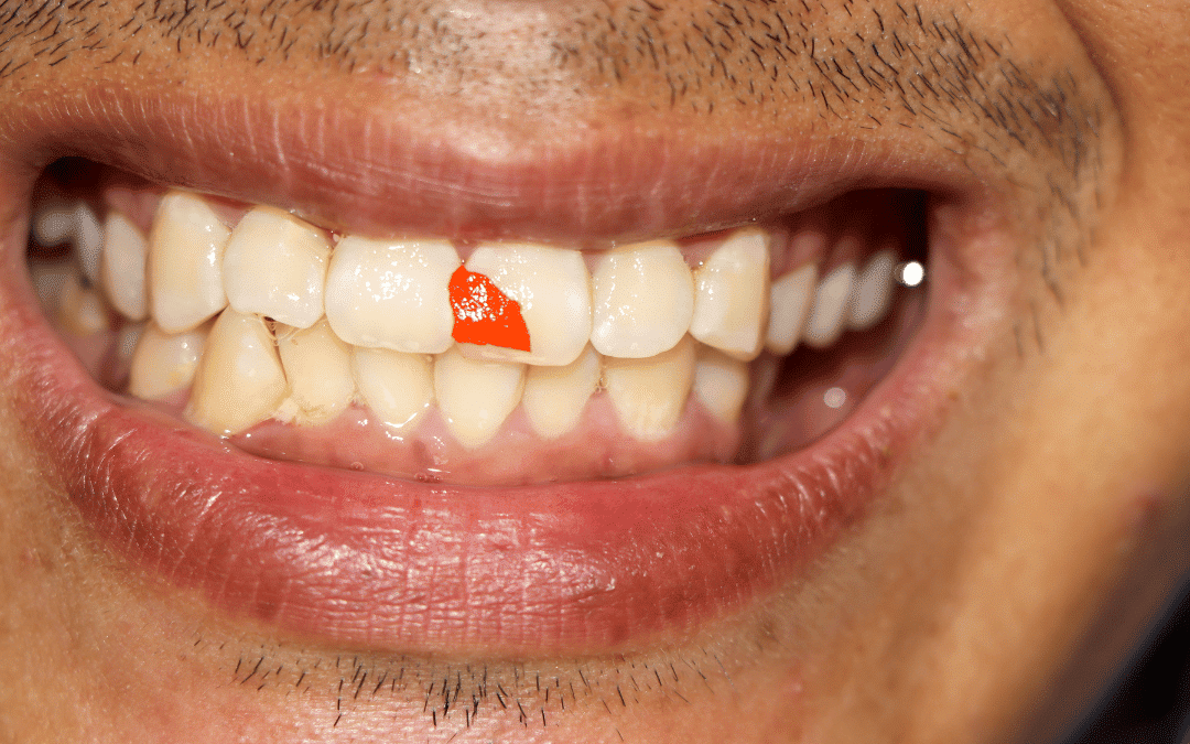 food-in-teeth
