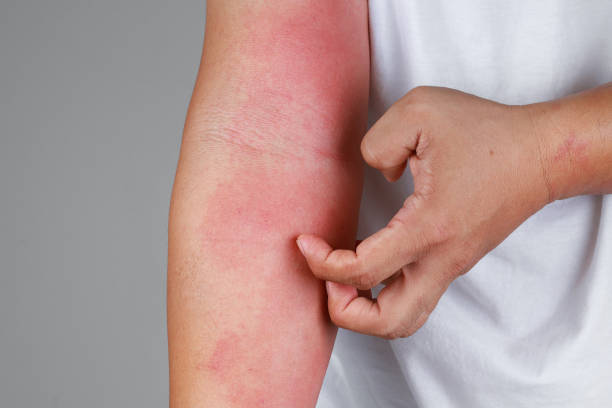 a-close-up-of-bad-psoriasis-on-a-persons-arm-2