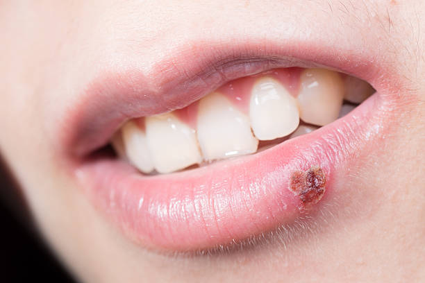 cold-sore-on-lip-cold-sores-are-caused-by-the-herpes-simplex-virus