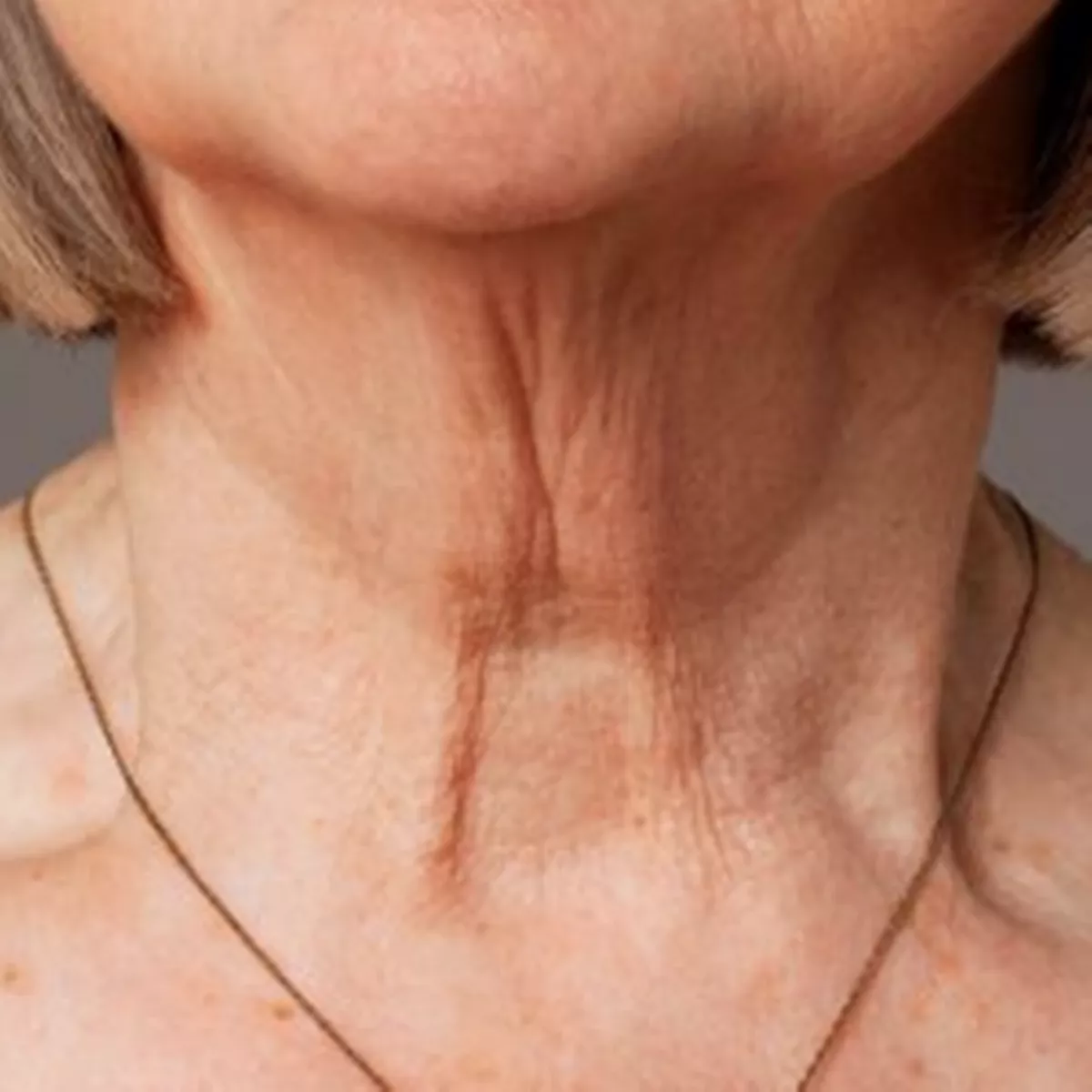 neck-wrinkles