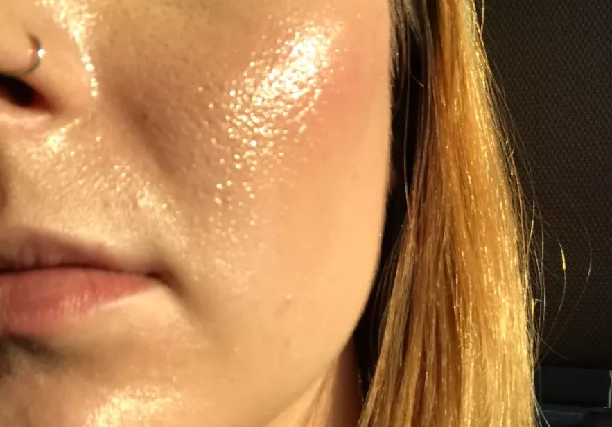 oily-skin-883x1024