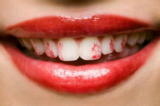 red-lip