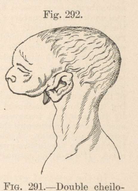 synotia-and-agnathia-otocephaly-a34926-640