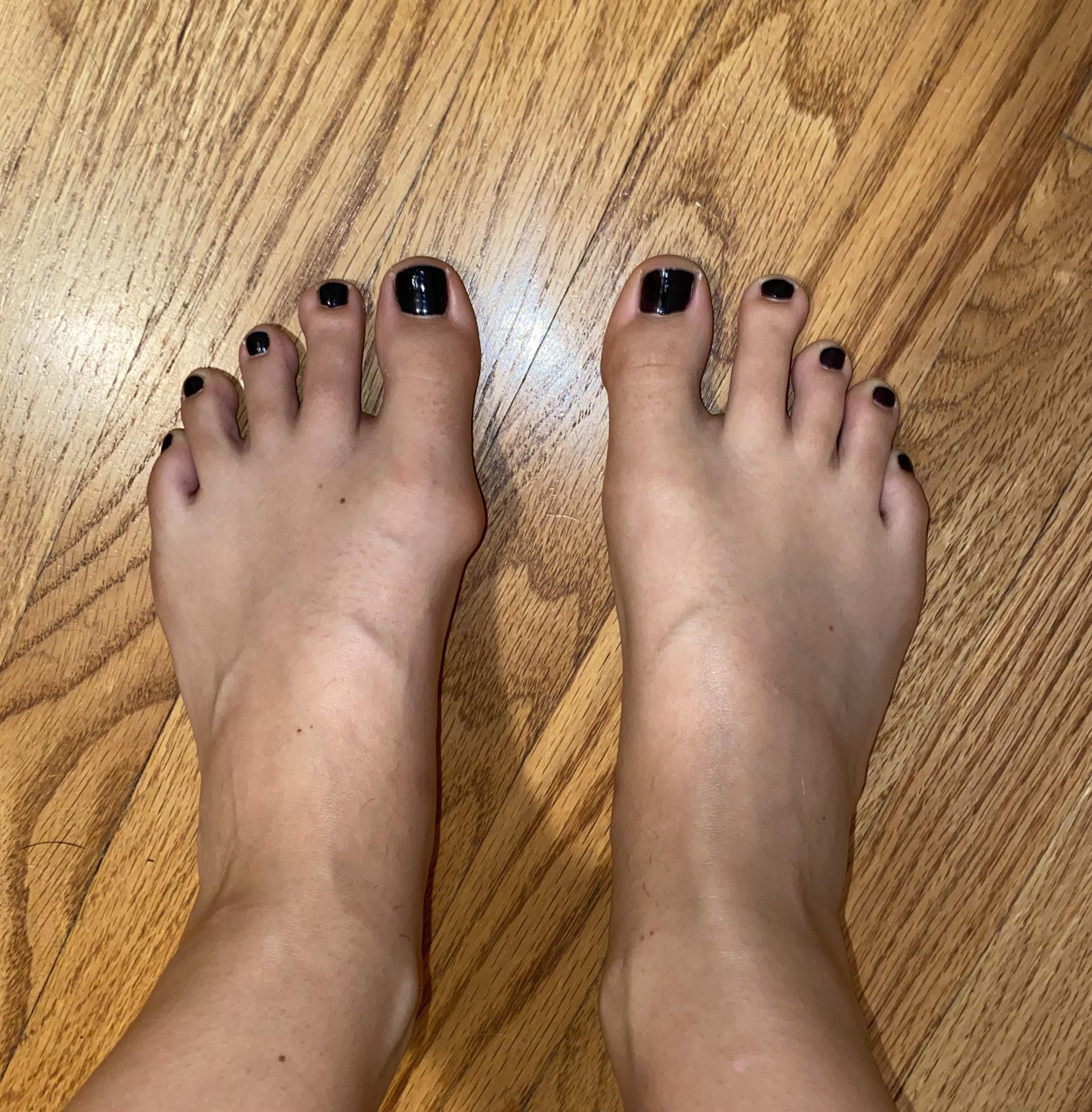 bunions-scaled