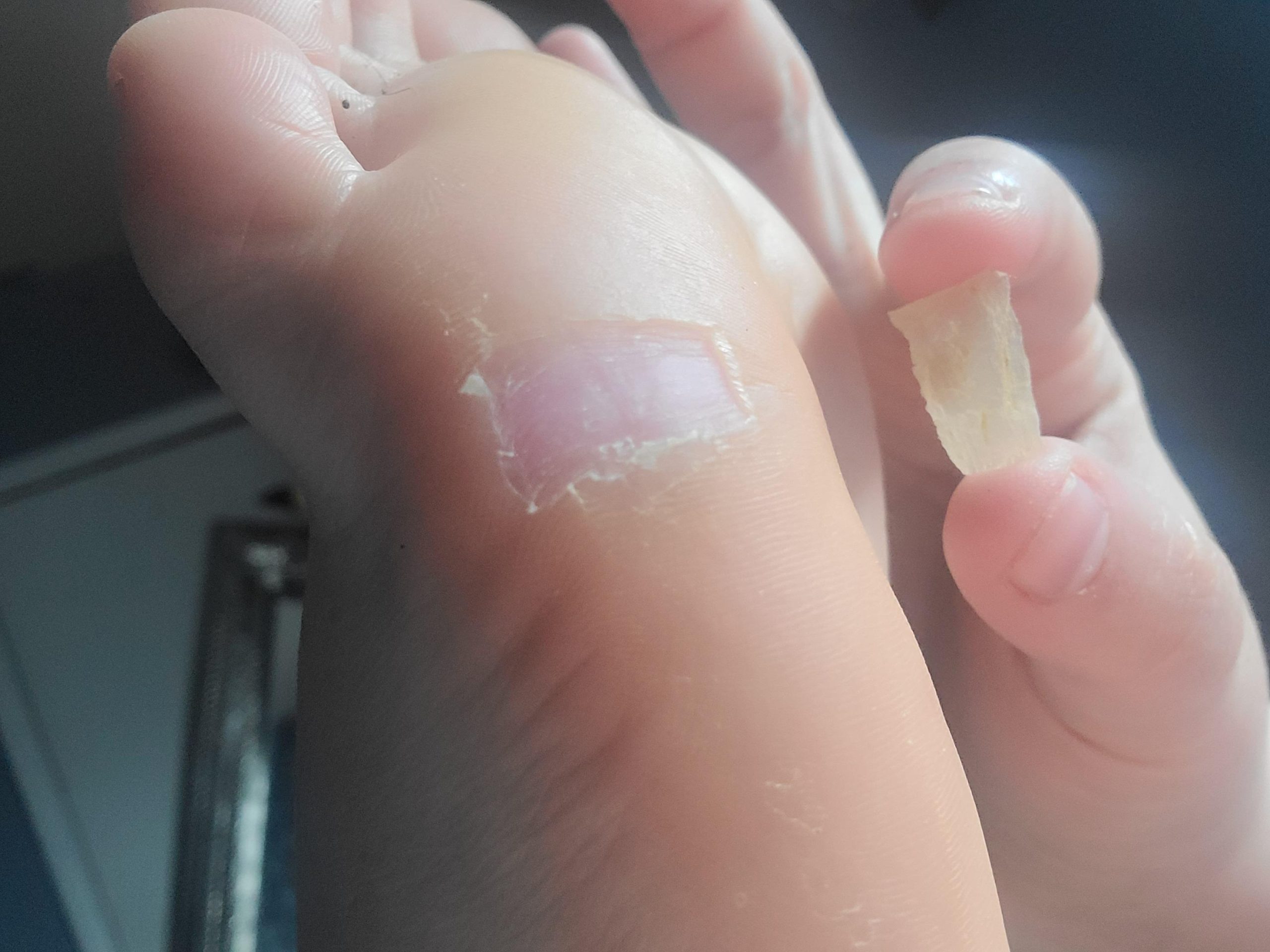callus-removal-scaled
