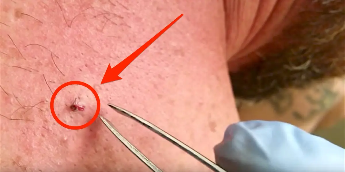ingrown-2