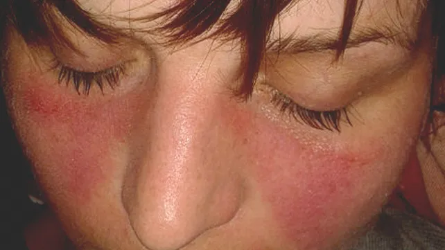679-lupus_pictures-642x361-slide1