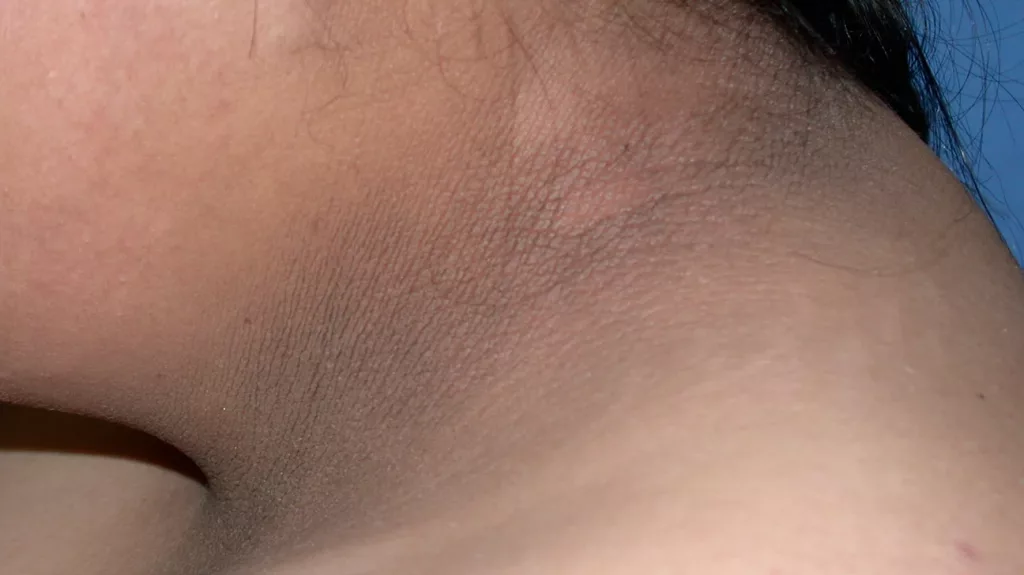 acanthosis-nigricans-body1