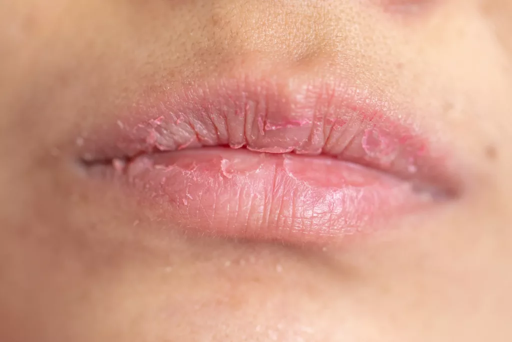 chapped_lips_essentials_stock_2121x