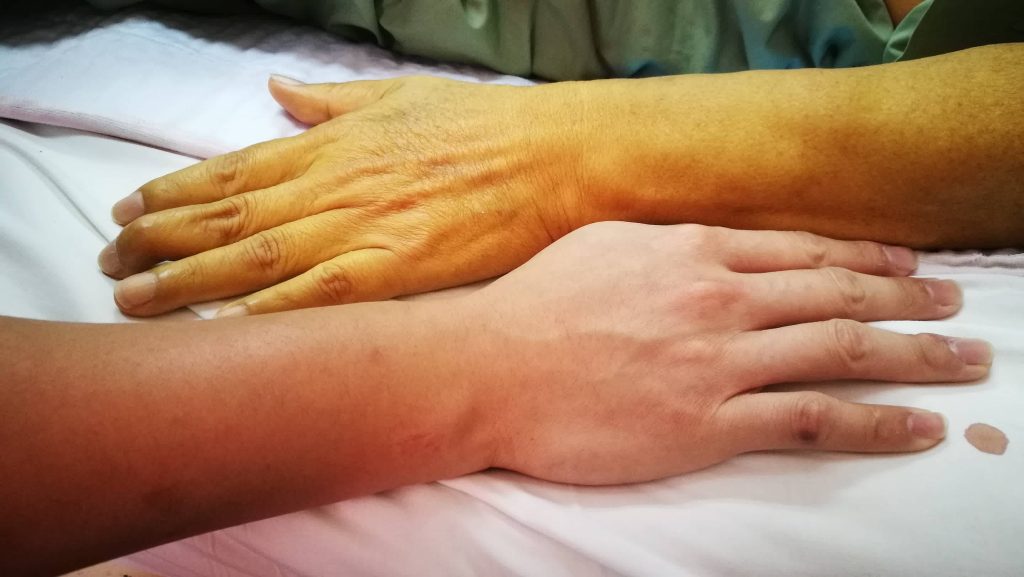 causes_of_jaundice_yellow_looking_skin