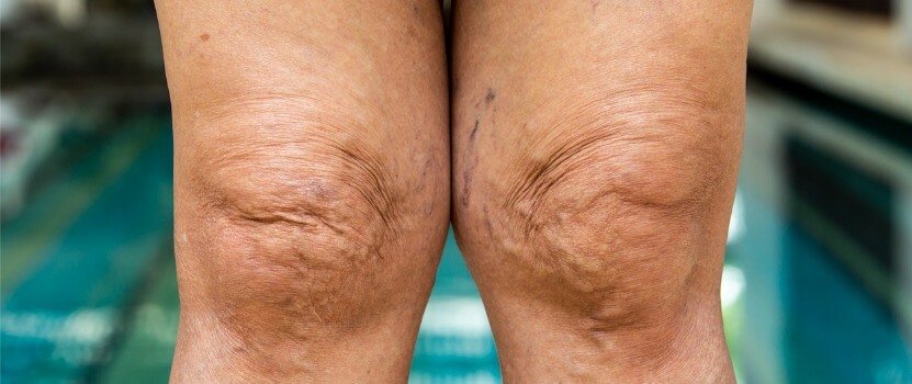 how-to-get-rid-of-crepey-skin-on-legs