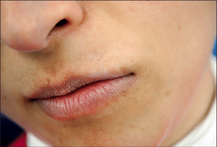 intermingled-white-patches-and-erythematous-areas-on-the-mucosa-of-the-upper-lip-x1-2