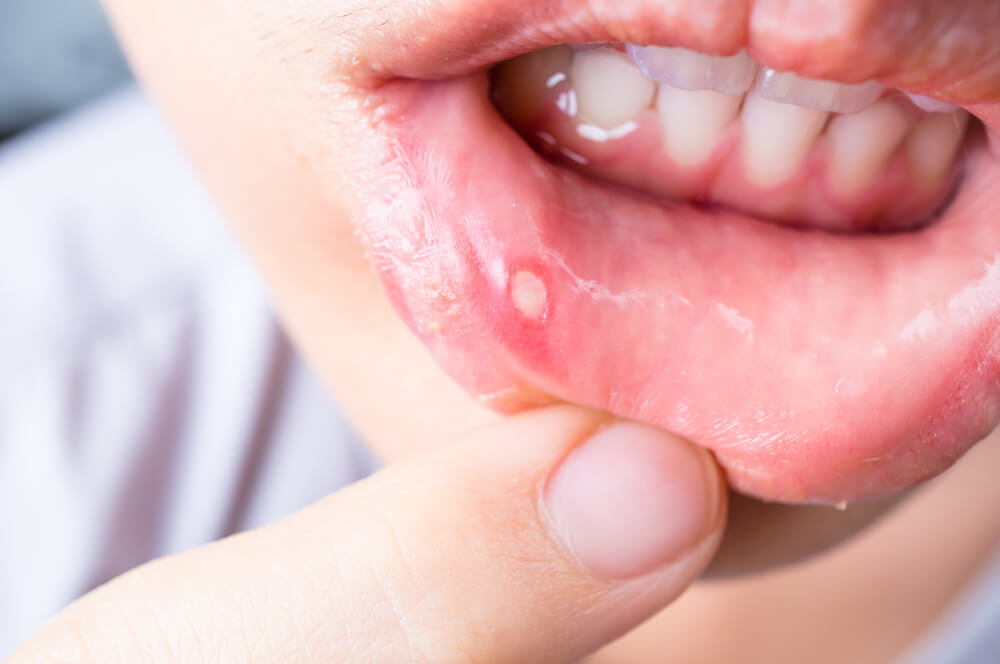 mouth-ulcer-lip