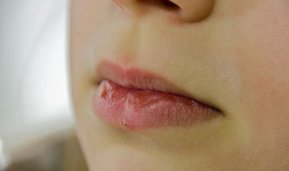 vitamin-b12-deficiency-symptoms-the-sign-in-your-lips-your-diet-could-be-lacking-b12-2432504