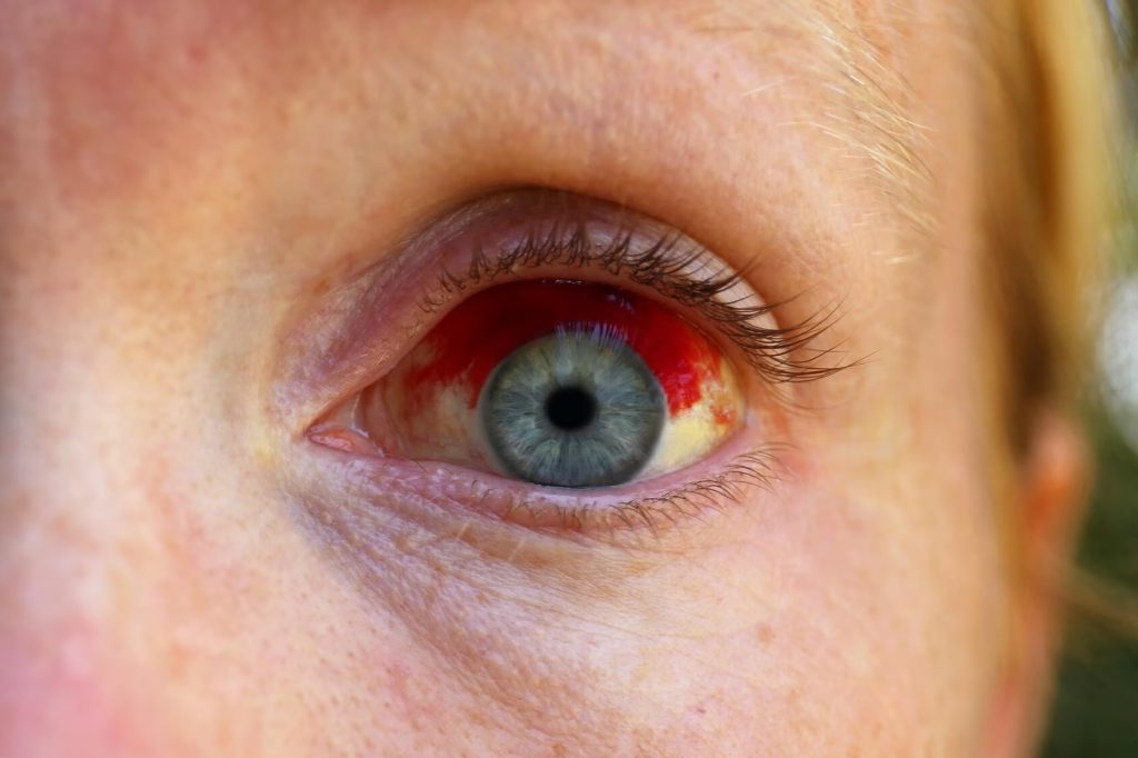 broken-blood-vessel-in-the-eye-copy