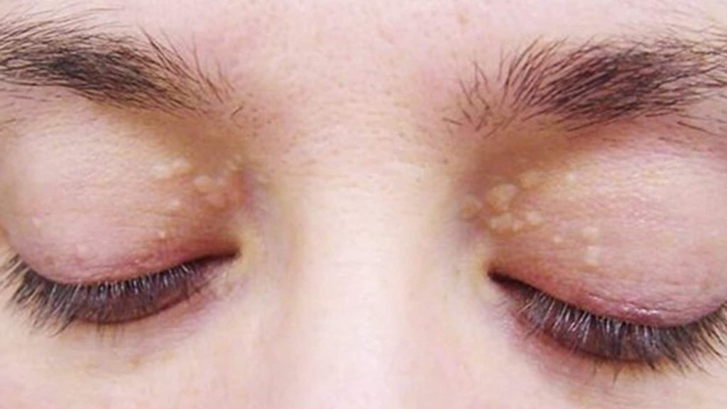 cholesterol_in_eyes_1660302558658_1660302574535_1660302574535
