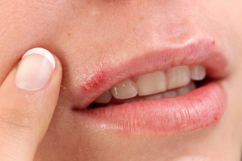 herpes-2