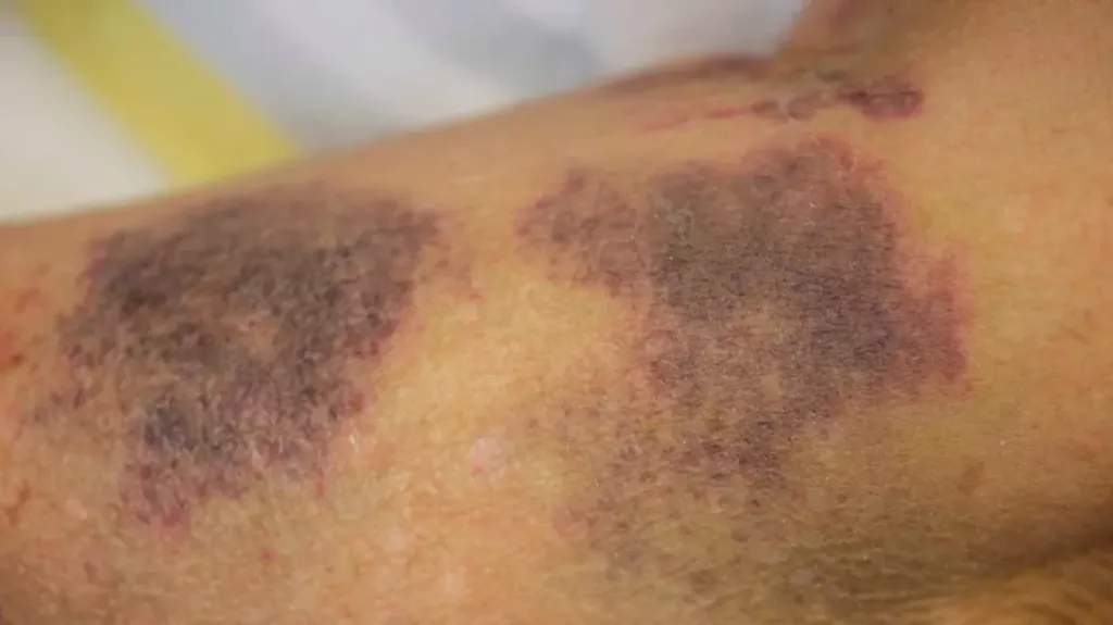 purpura-skin-slide1